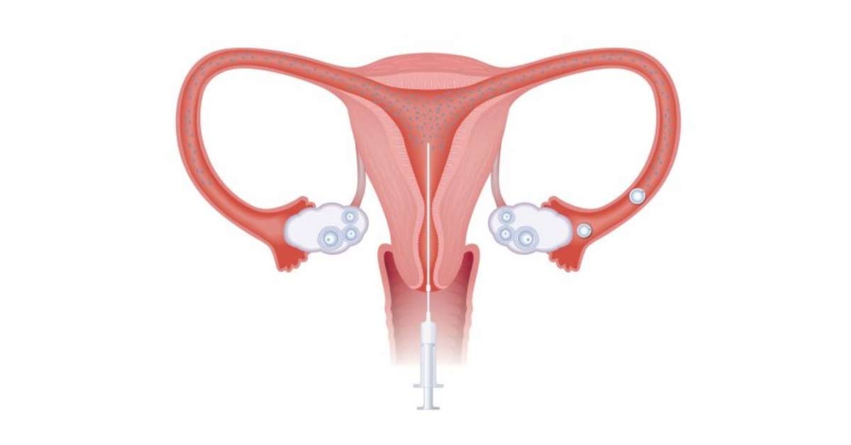 Inseminação Artificial